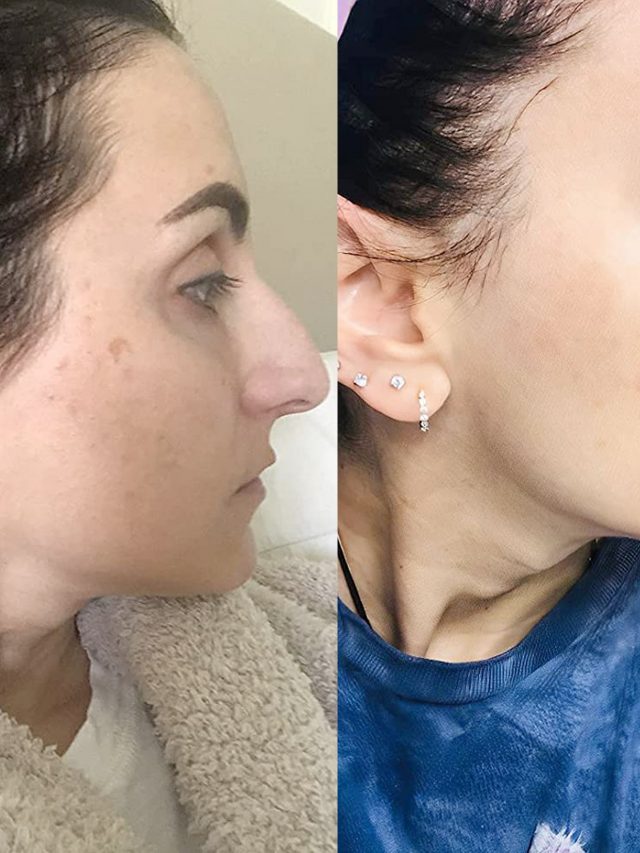 Skin Dark Spot Correctors – The Complete Guide to and How They Work